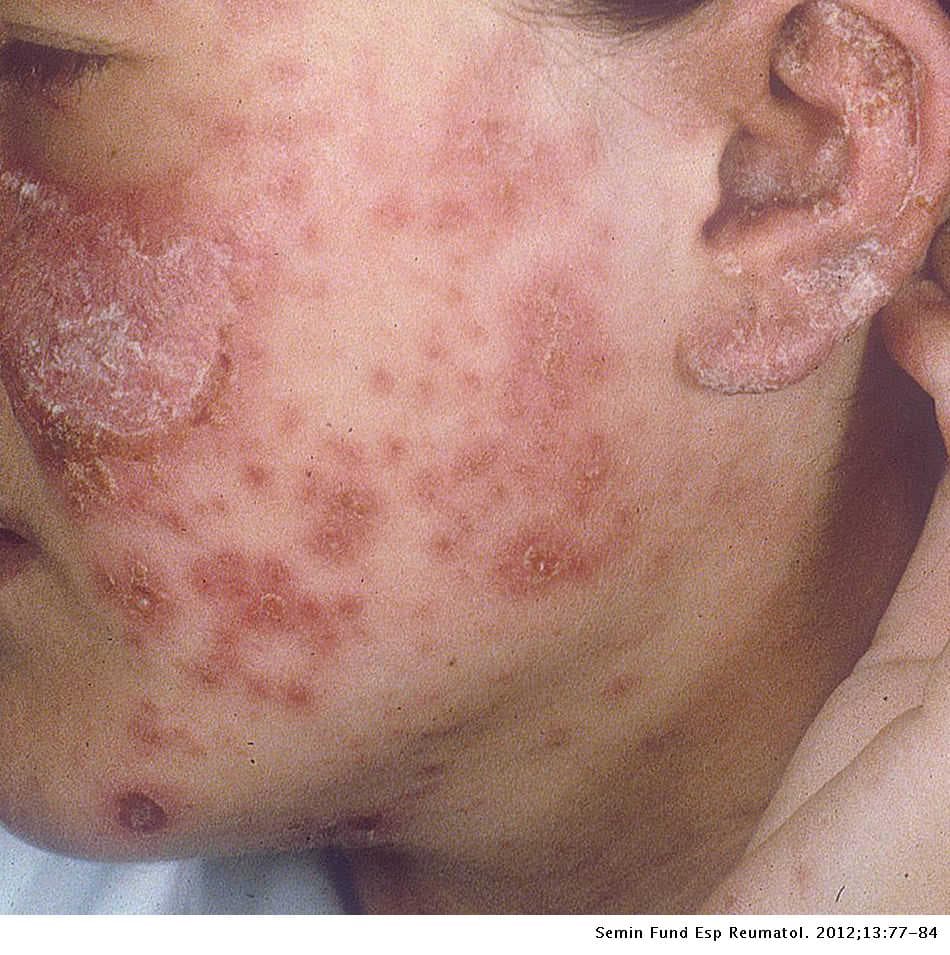 Fotografía clínica de la cara con múltiples placas eritematosas, algunas con escama adherente, tapones foliculares y atrofia central, distribuidas en mejilla y pabellón auricular, compatible con lupus eritematoso discoide crónico. Útil para reconocer las placas discoides cicatriciales con afectación del pabellón auricular. Pie de imagen: Semin Fund Esp Reumatol. 2012;13:77-84.