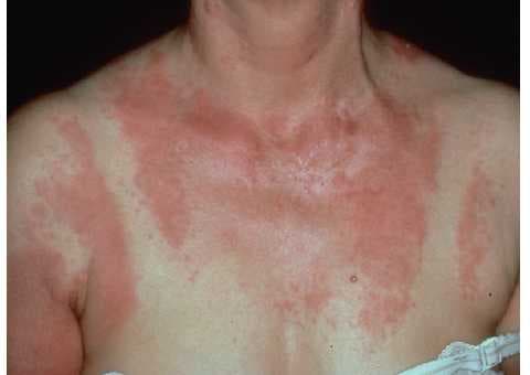 Fotografía clínica del tórax y cuello con placas eritematosas confluentes en zonas fotoexpuestas (escote, hombros y región anterior del cuello), compatible con lupus eritematoso cutáneo subagudo / exantema fotosensible. Útil para reconocer la distribución en áreas expuestas al sol del exantema lúpico.