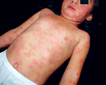 Foto clínica de un niño con exantema maculopapular eritematoso generalizado en cara, tronco y extremidades (barra negra sobre los ojos para anonimizar). Útil como ejemplo de erupción cutánea sistémica.
