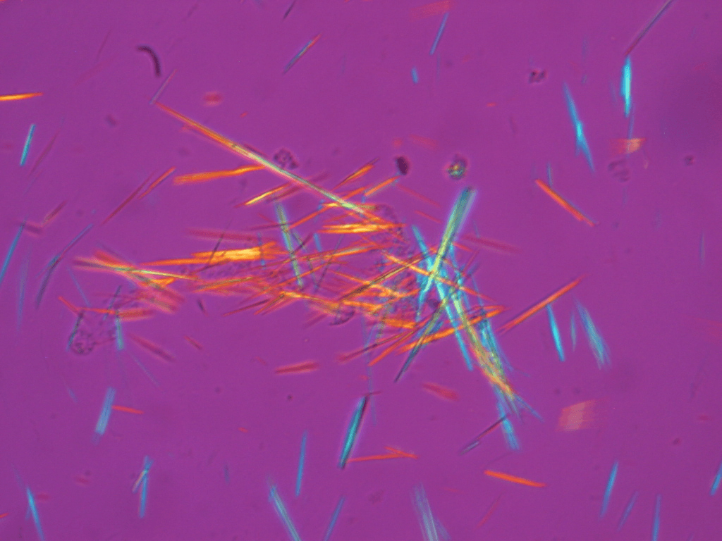 Microfotografía con microscopía de luz polarizada del líquido sinovial en gota: cristales de urato monosódico en forma de aguja, con birrefringencia negativa fuerte (amarillos cuando se orientan paralelos al eje del compensador y azules cuando son perpendiculares). Hallazgo diagnóstico de la gota.
