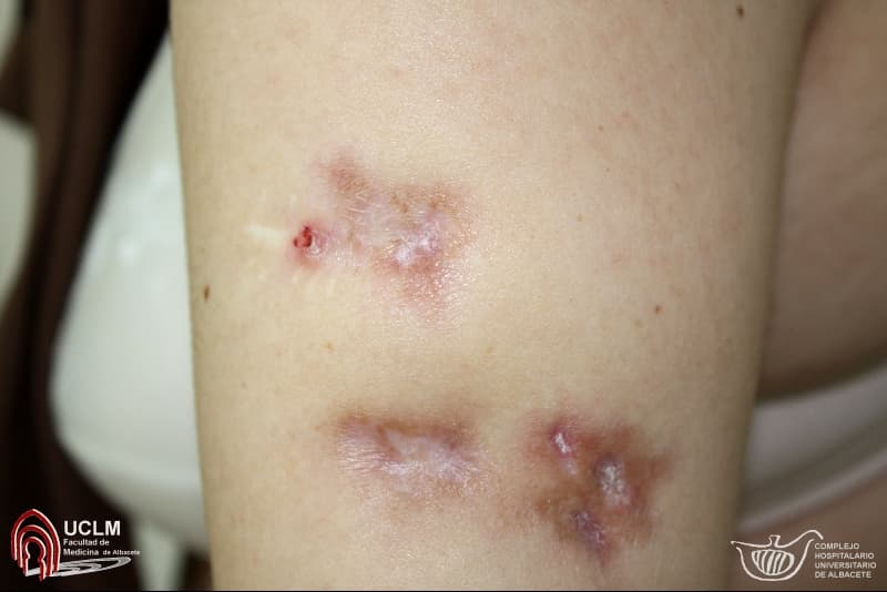 Foto clínica del brazo con lesiones cutáneas atróficas, deprimidas y cicatriciales de borde violáceo, compatibles con paniculitis lúpica (lupus profundo): la inflamación del tejido celular subcutáneo deja áreas de lipoatrofia residual.