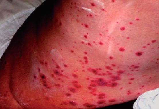 Fotografía clínica de la piel con múltiples lesiones purpúricas (petequias y púrpura palpable) de color rojo-violáceo que no desaparecen a la digitopresión. Útil para reconocer la púrpura como manifestación cutánea de vasculitis asociada al lupus eritematoso sistémico.
