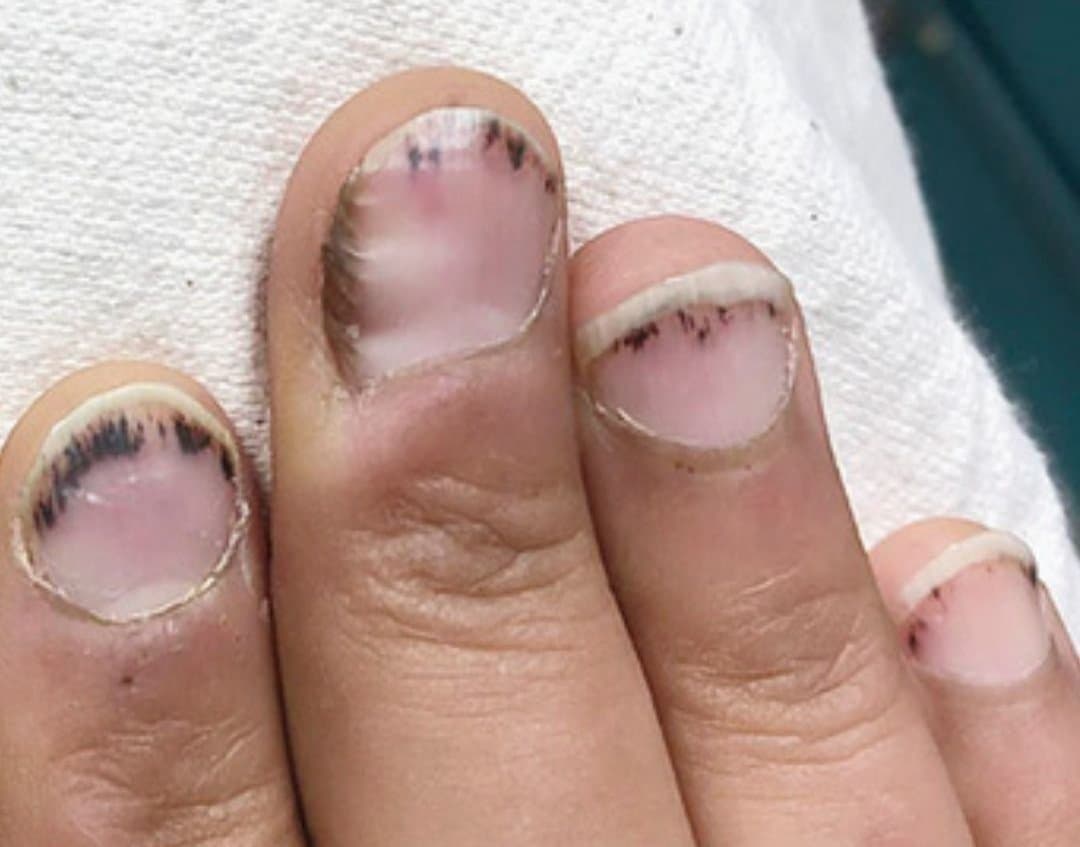 Foto clínica de varios dedos mostrando finas estrías lineales oscuras (rojo-pardas a negras) en el lecho ungueal distal: hemorragias en astilla, hallazgo asociado a vasculitis, endocarditis infecciosa y lupus eritematoso sistémico.