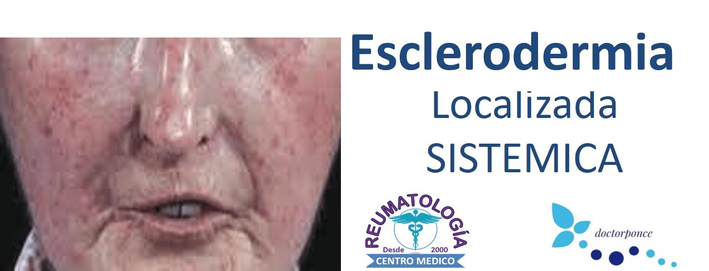 Fotografía clínica del rostro de un paciente con esclerodermia que muestra la facies esclerodérmica (piel tensa y brillante, telangiectasias). Banner introductorio del tema "Esclerodermia Localizada / Sistémica" con logos de Reumatología Centro Médico y doctorponce.