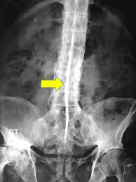 Radiografía de columna lumbar (proyección AP) en espondilitis anquilosante avanzada que muestra "columna en caña de bambú" (bamboo spine): puente óseo continuo por sindesmofitos que une los cuerpos vertebrales y osificación de los ligamentos espinales (flecha amarilla sobre la línea media osificada).