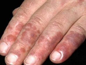 Foto clínica del dorso de la mano y los dedos con patrón reticulado violáceo-eritematoso: livedo reticularis, hallazgo cutáneo asociado a lupus eritematoso sistémico y al síndrome antifosfolípido.