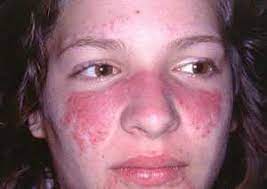 Fotografía clínica de eritema malar ("en alas de mariposa") en una paciente con lupus eritematoso sistémico: rash eritematoso sobre mejillas y dorso nasal que respeta los pliegues nasolabiales.