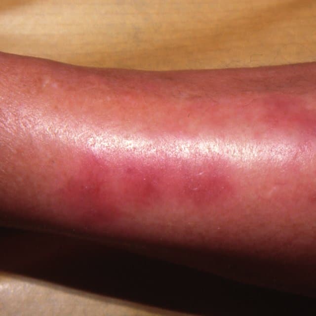 Foto clínica de una pierna con placa eritematosa, caliente, edematosa y de bordes mal definidos en cara anterior. Hallazgo compatible con paniculitis/eritema nodoso o celulitis.