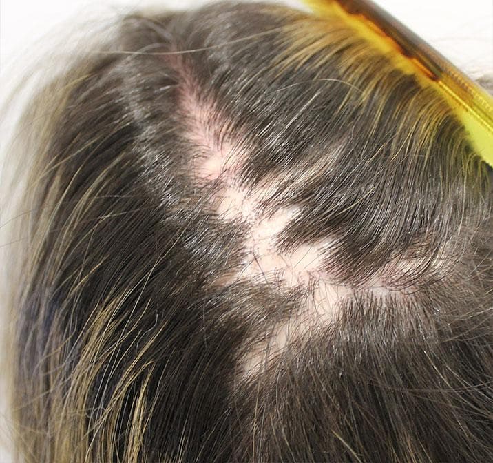 Foto clínica del cuero cabelludo que muestra múltiples placas de alopecia cicatricial con pérdida de pelo en parches y zonas de piel lisa y brillante. Hallazgo compatible con alopecia discoide cicatricial del lupus eritematoso discoide (lupus cutáneo crónico).