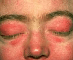 Foto clínica del rostro con eritema violáceo y edema en ambos párpados y región periorbitaria (exantema en heliotropo), signo cutáneo característico de la dermatomiositis.