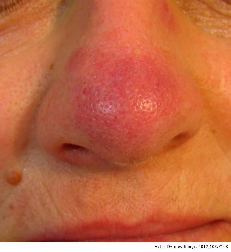Fotografía clínica de la nariz con eritema y tumefacción violácea del dorso nasal, compatible con lupus pernio (placa infiltrada de coloración rojo-violácea en zona acra). Útil para reconocer la presentación cutánea del lupus pernio en el estudio de manifestaciones dermatológicas. Pie de imagen: Actas Dermosifiliogr. 2012;103:71-3.