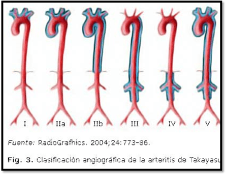 Esquema anatómico de la aorta y sus ramas que ilustra los seis tipos de la clasificación angiográfica de la arteritis de Takayasu (I, IIa, IIb, III, IV y V), según el segmento vascular afectado. Fuente: RadioGraphics. 2004;24:773-86.