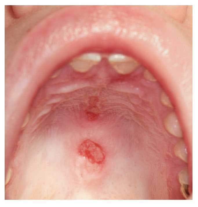 Foto clínica de la cavidad oral que muestra úlceras orales en el paladar duro (lesiones eritematosas con centro erosivo). Hallazgo característico (úlceras orales indoloras) de los criterios de lupus eritematoso sistémico.