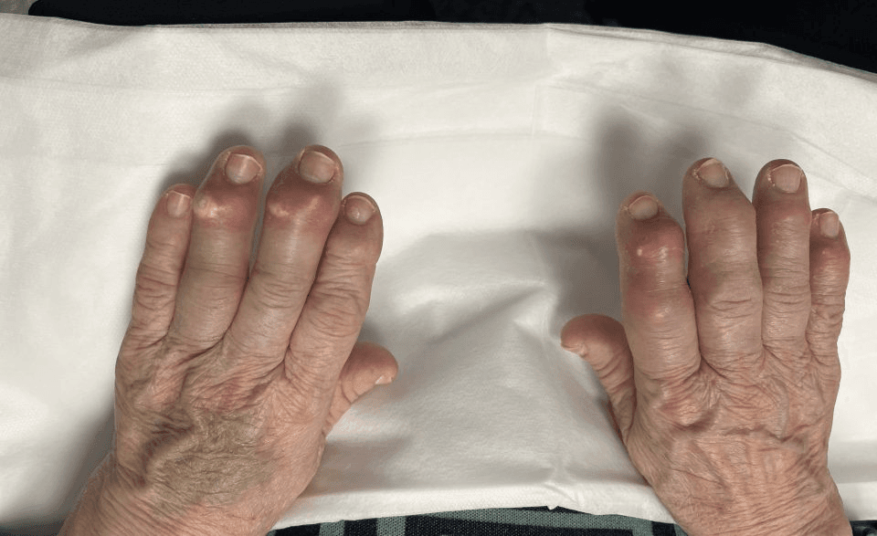 Fotografía clínica de ambas manos de un paciente que muestra múltiples tofos gotosos: nódulos subcutáneos firmes y deformantes con coloración eritemato-violácea sobre las articulaciones interfalángicas de los dedos. Útil para reconocer la gota tofácea crónica.