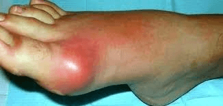 Foto clínica de un pie con artritis gotosa aguda: tumefacción intensa, eritema y edema sobre la articulación metatarsofalángica del primer dedo (podagra), hallazgo clásico de un ataque agudo de gota.