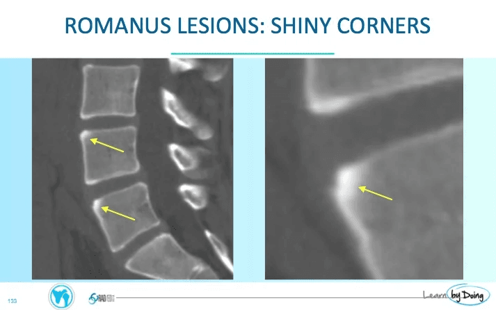 Imágenes de TC de columna que muestran las lesiones de Romanus ("esquinas brillantes" o "shiny corners"), hallazgo característico de la espondilitis anquilosante: esclerosis/inflamación en los ángulos vertebrales (señalada por las flechas amarillas) por entesitis en la inserción del anillo fibroso.