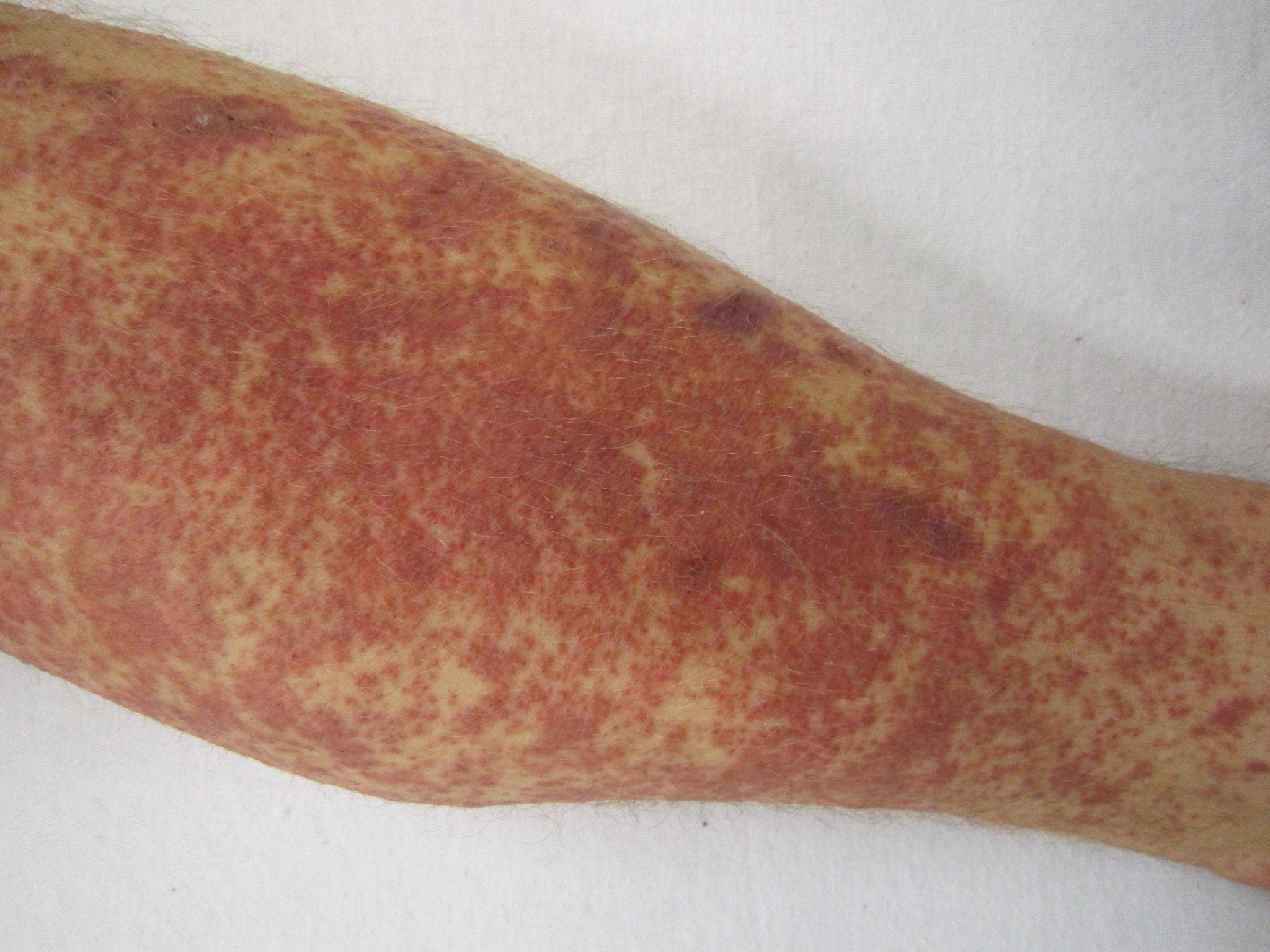 Foto clínica de una extremidad inferior con exantema purpúrico/petequial confluente de aspecto reticulado y livedoide. Compatible con vasculitis cutánea o livedo reticularis en el contexto de enfermedad del tejido conectivo.