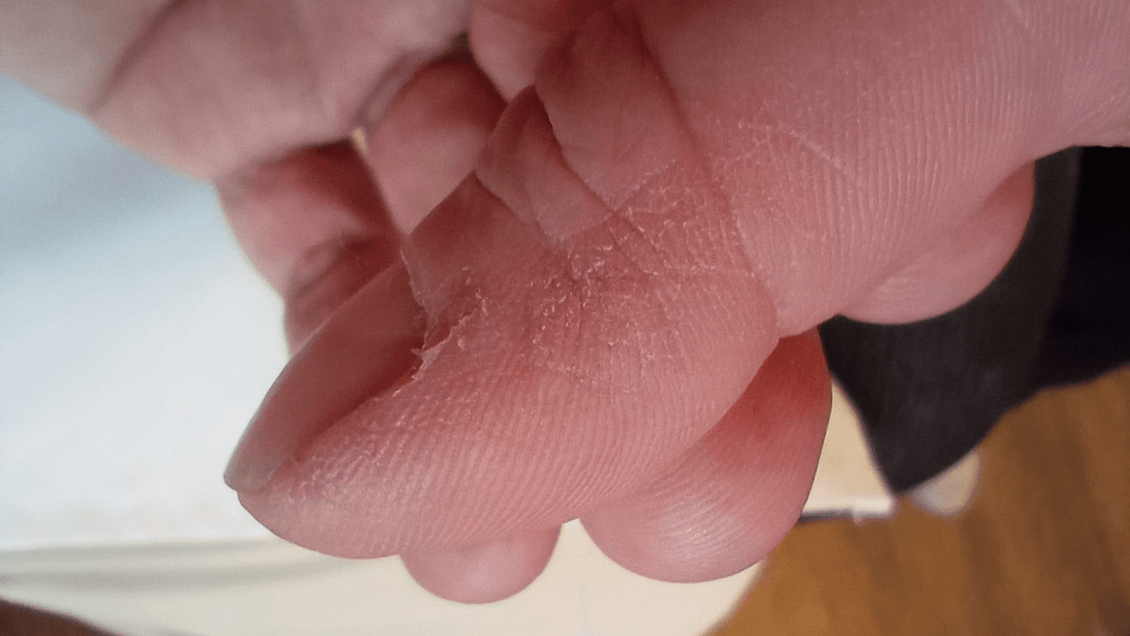 Foto clínica del dedo de una mano que muestra hiperqueratosis, descamación y fisuras en la cara lateral/pulpejo, hallazgo característico de las "manos de mecánico" en el síndrome antisintetasa asociado a miopatías inflamatorias (dermatomiositis/polimiositis).
