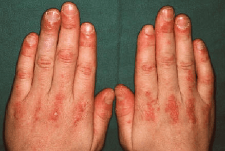 Foto clínica del dorso de ambas manos con pápulas eritemato-violáceas sobre las articulaciones metacarpofalángicas e interfalángicas (pápulas de Gottron), signo cutáneo característico de la dermatomiositis.