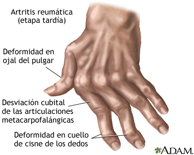 Ilustración de una mano con artritis reumatoide en etapa tardía que muestra las deformidades clásicas: deformidad en ojal del pulgar, desviación cubital de las articulaciones metacarpofalángicas y deformidad en cuello de cisne de los dedos. Útil para reconocer las deformidades articulares avanzadas de la AR.