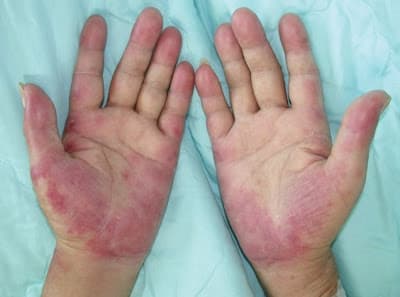 Foto clínica de ambas palmas que muestran eritema palmar difuso con máculas y placas eritematosas. Hallazgo cutáneo asociado a enfermedades del tejido conectivo como el lupus eritematoso sistémico.