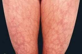 Fotografía clínica de ambas piernas con patrón reticulado eritematoso-violáceo en malla (livedo reticularis) sobre la piel. Útil para reconocer la livedo reticularis como manifestación cutánea asociada al lupus y al síndrome antifosfolipídico.
