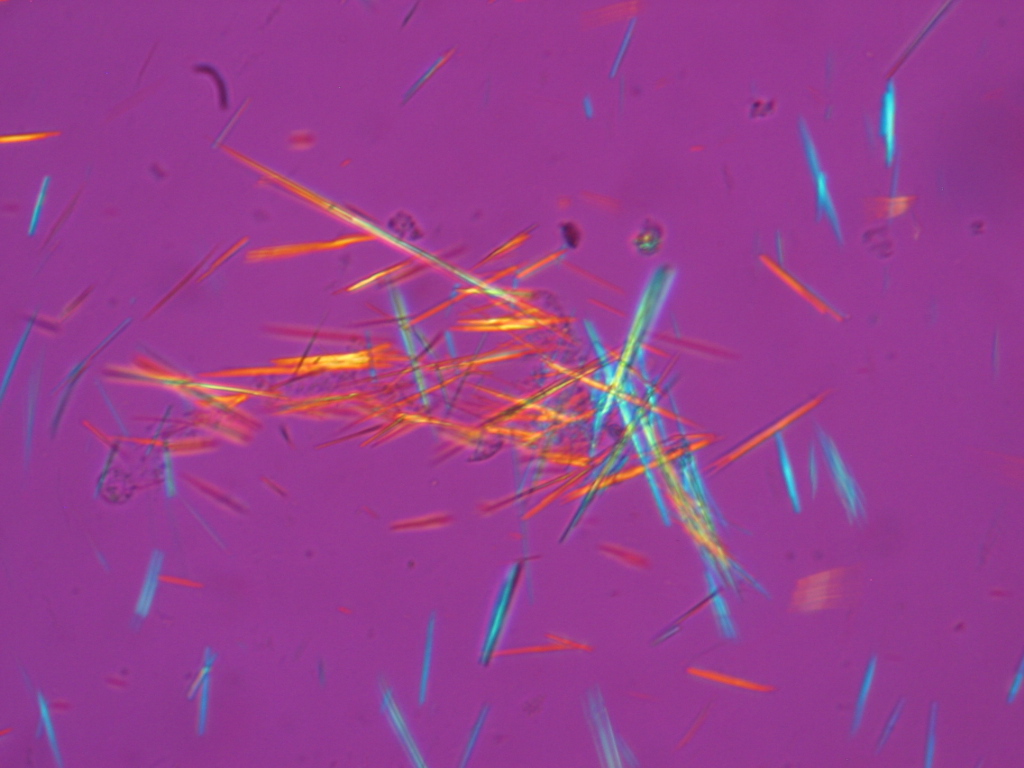 Microfotografía con microscopía de luz polarizada del líquido sinovial en gota: cristales de urato monosódico en forma de aguja, con birrefringencia negativa fuerte (amarillos cuando se orientan paralelos al eje del compensador y azules cuando son perpendiculares). Hallazgo diagnóstico de la gota.