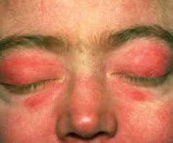 Foto clínica del rostro con eritema violáceo y edema en ambos párpados y región periorbitaria (exantema en heliotropo), signo cutáneo característico de la dermatomiositis.