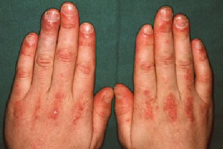Foto clínica del dorso de ambas manos con pápulas eritemato-violáceas sobre las articulaciones metacarpofalángicas e interfalángicas (pápulas de Gottron), signo cutáneo característico de la dermatomiositis.