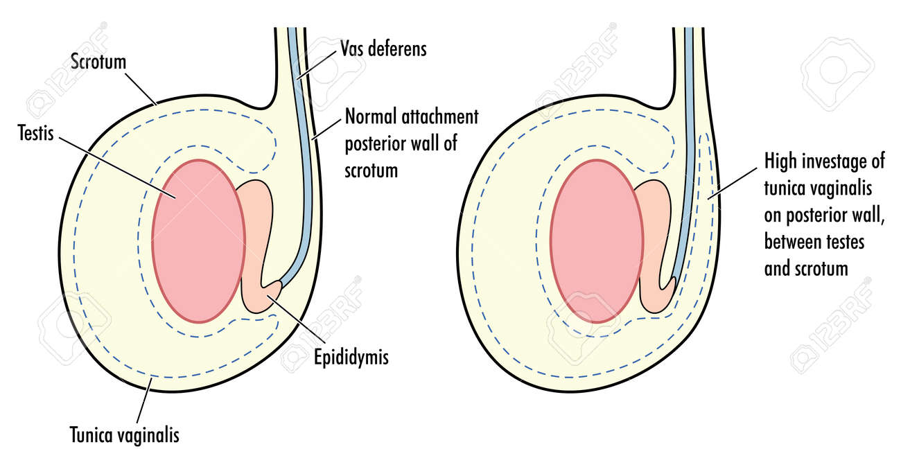 Esquema comparativo de la fijación de la túnica vaginal en el escroto: a la izquierda, inserción normal en la pared posterior del escroto; a la derecha, deformidad en "badajo de campana" (bell clapper) con inserción alta de la túnica vaginal que rodea el testículo y predispone a torsión testicular. Etiqueta las estructuras: escroto, testículo, epidídimo, conducto deferente y túnica vaginal.
